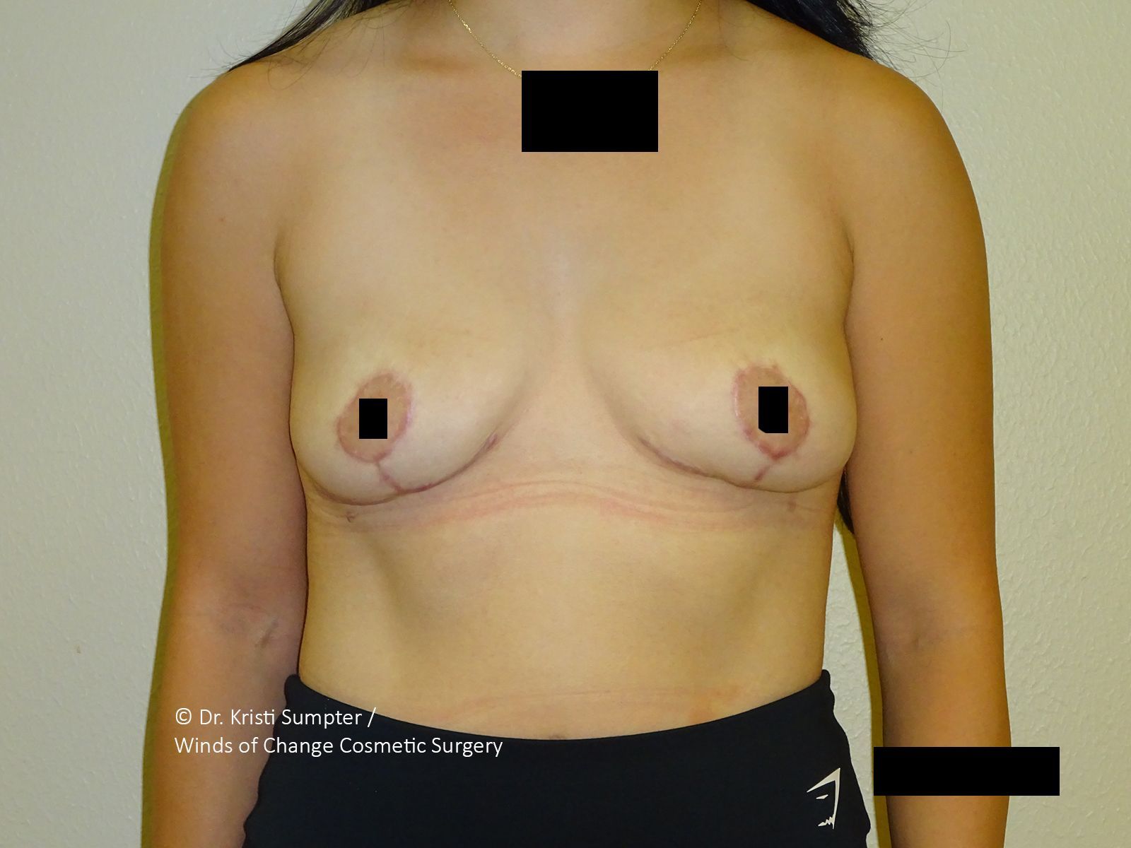 Torso of a person with a bare chest; nipple covered by a black square.