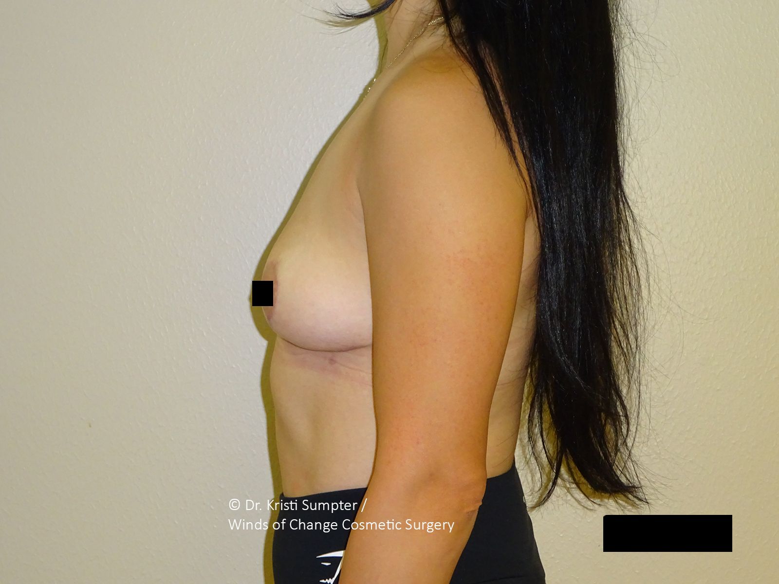 Torso of a person, the right nipple is obscured with a black square.