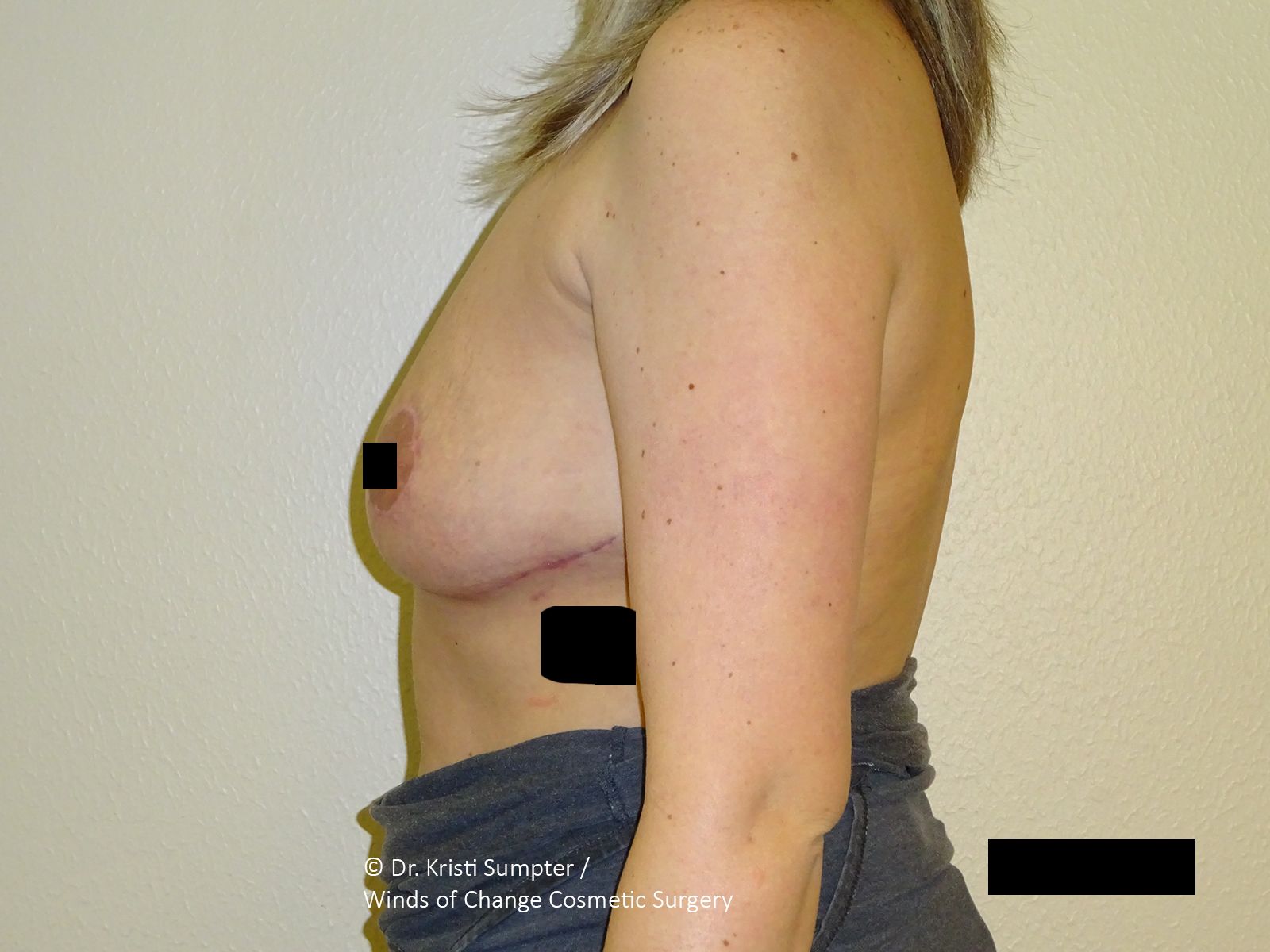 Upper torso of a person with a surgical scar on the left breast, nipple obscured.