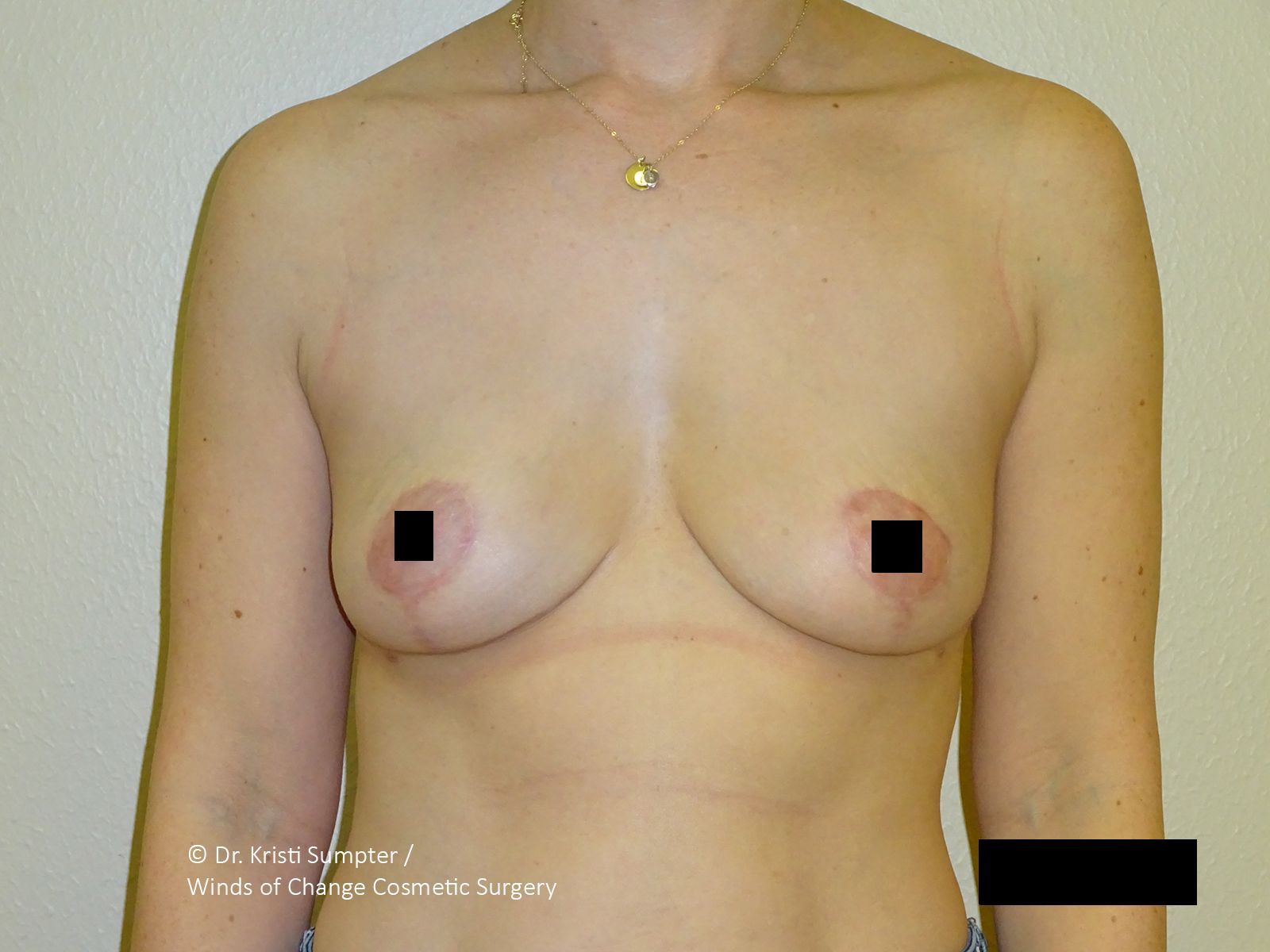 Torso of a person with bare breasts, small black squares covering the nipple and lower breast area.