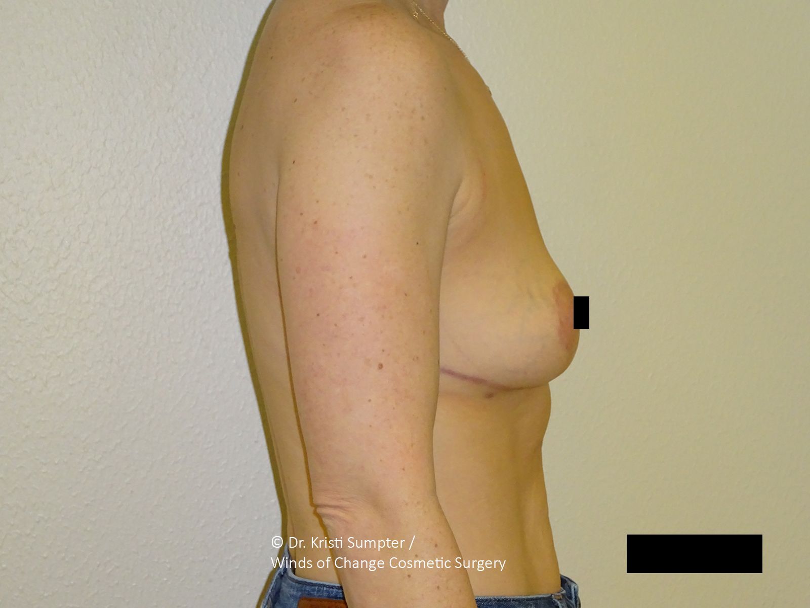 Close-up of a person's chest, skin-toned, with one nipple covered by a black square.