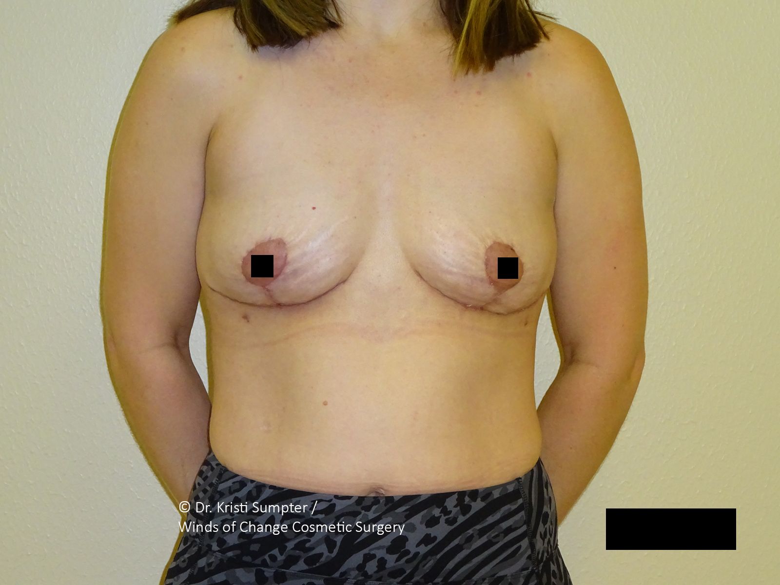 Woman's chest, showing a breast with a surgical scar, nipple covered by a black square.