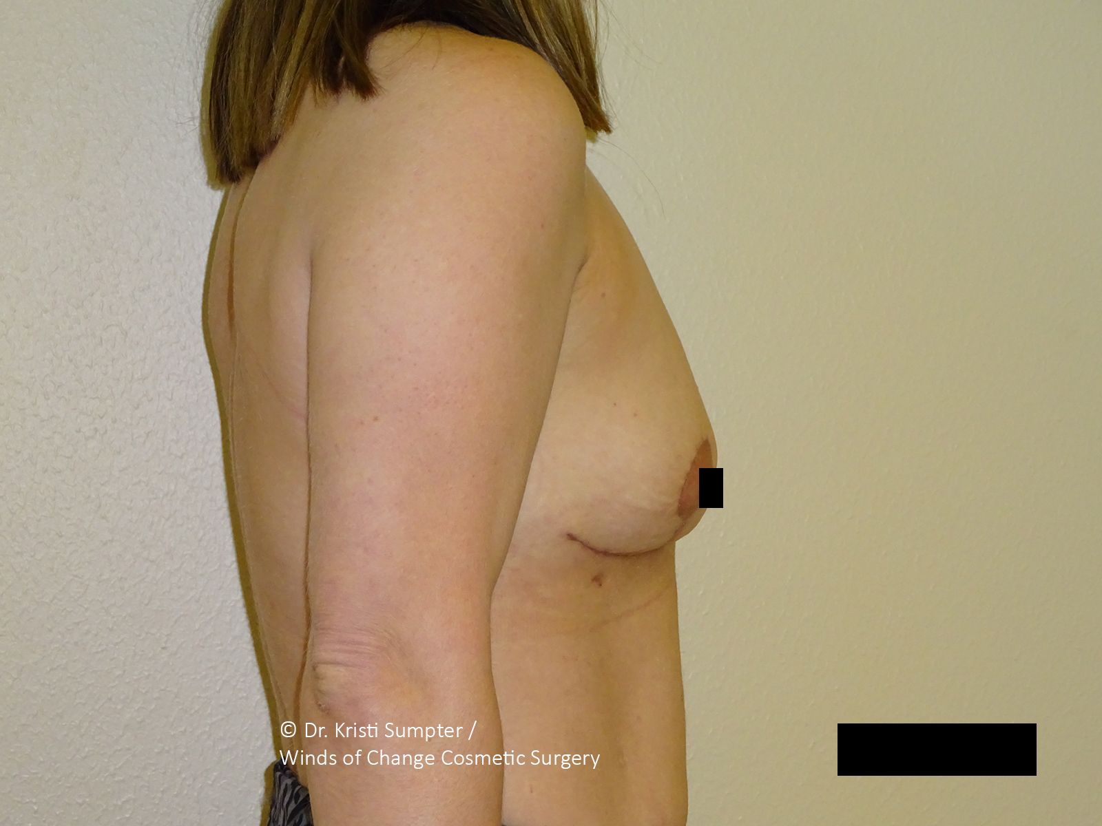 A person's torso and right breast, skin-toned, with a black square covering the nipple.