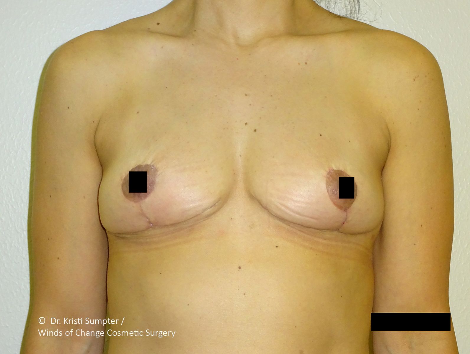 A person's torso, featuring the chest and arm. The right nipple is obscured by a black square.
