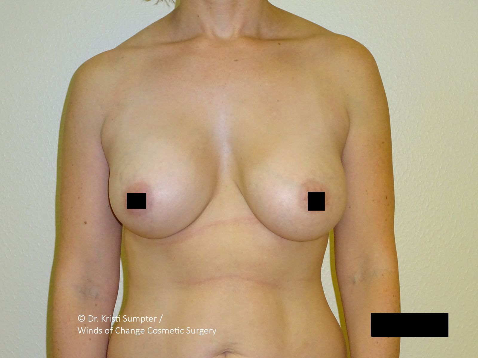 A person's torso with a breast; the nipple is obscured by a black square.