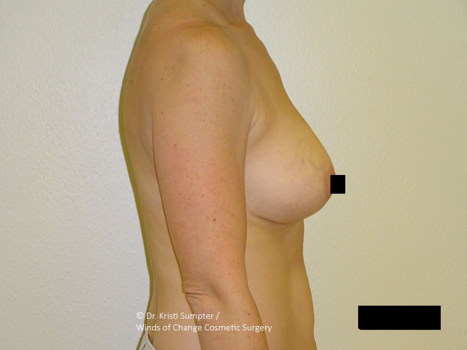 A person's torso with two breasts. The right nipple is obscured by a black square.