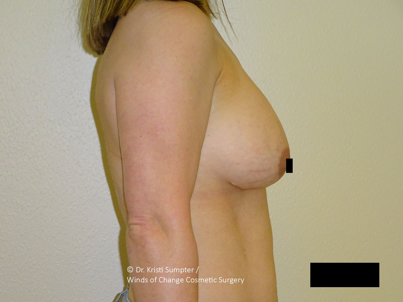 Torso of a person with bare breasts, partially obscured nipple. The person holds their arm.