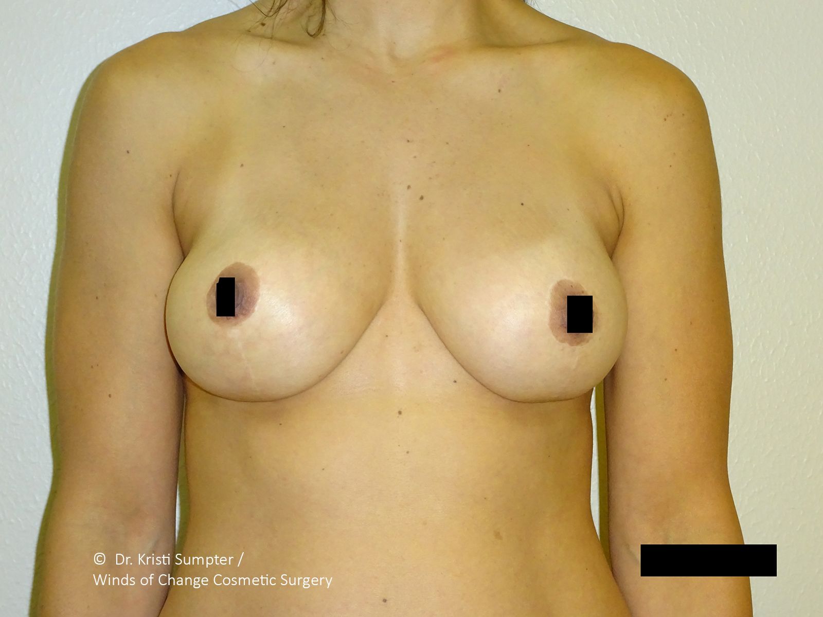 Upper torso of a person; one breast with a small black square covering the nipple.