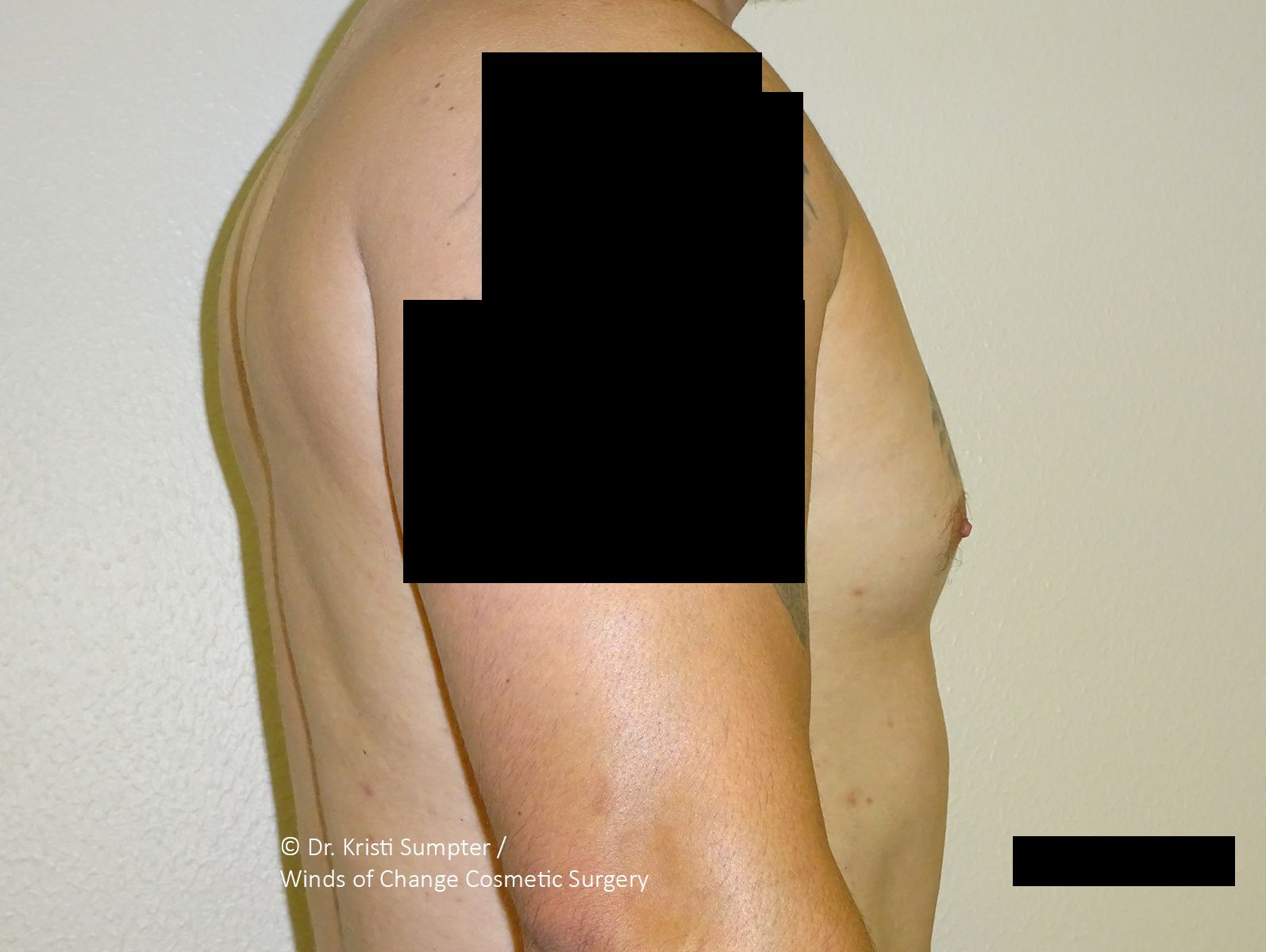 Side profile of a person’s upper torso and arm against a plain background, with black boxes obscuring parts of the image.
