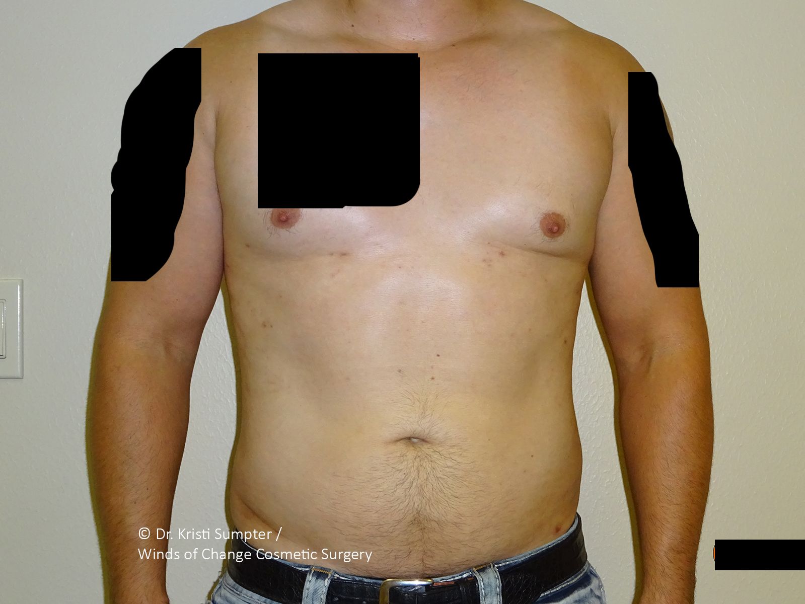 Torso and upper arms of an individual with black digital blocks obscuring areas of the chest and outer arms.