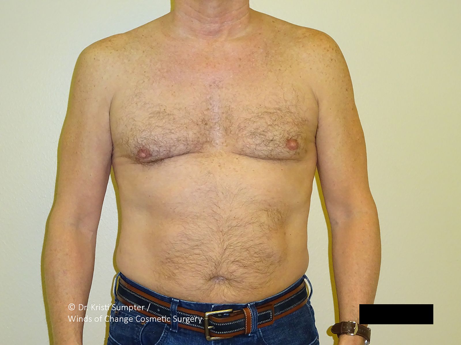 A frontal view of a person’s bare torso, showing the chest and abdominal area against a plain, light-colored background.