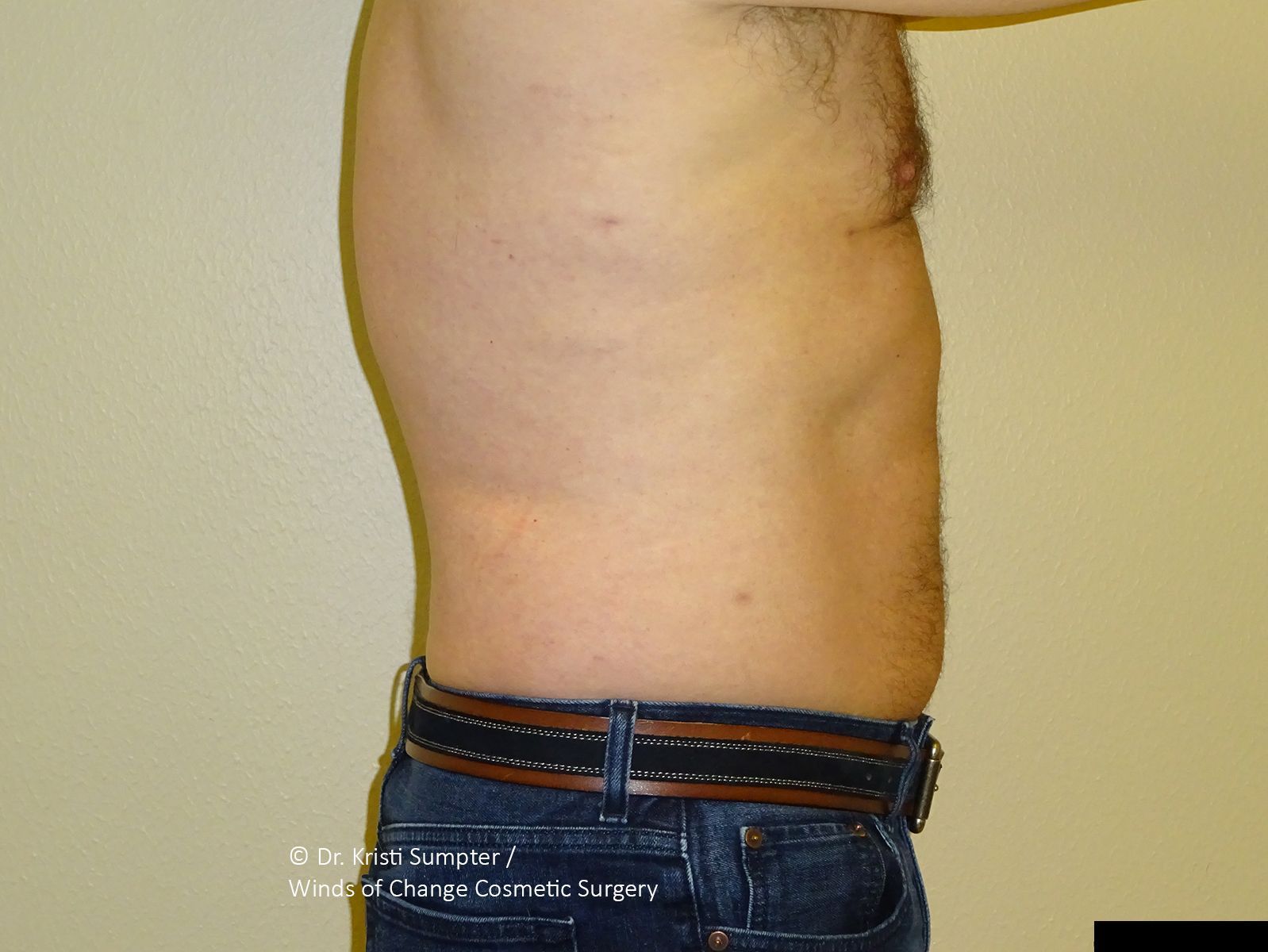 Side profile of a torso against a plain background, showing the abdominal area.