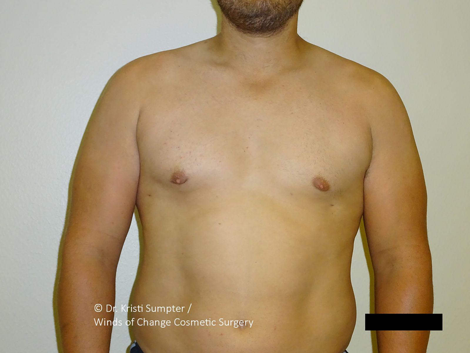 A shirtless person’s torso viewed from the front, against a plain background, with branding text in the bottom corners.