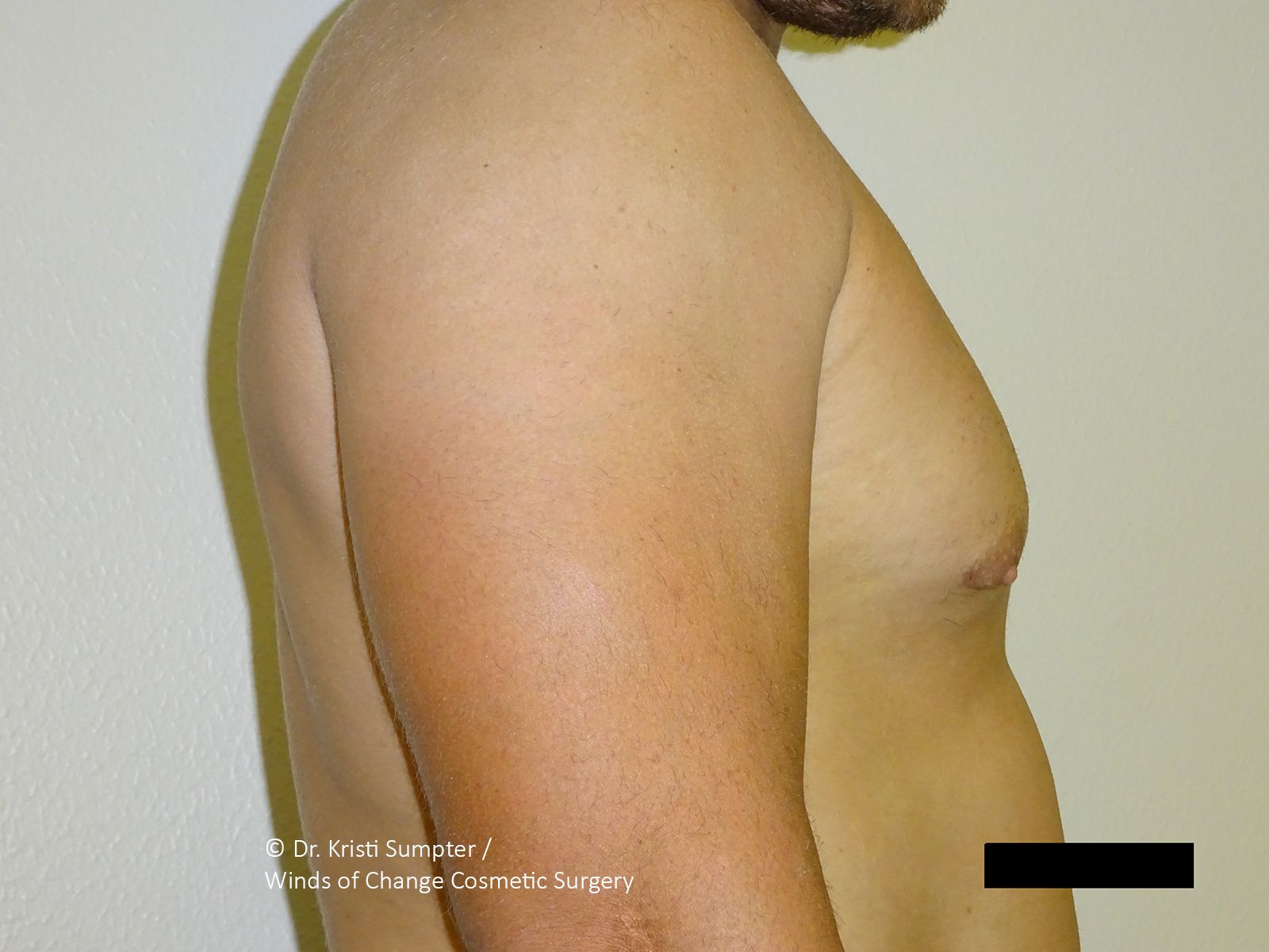 Profile view of a torso showing enlarged breast tissue consistent with gynecomastia.