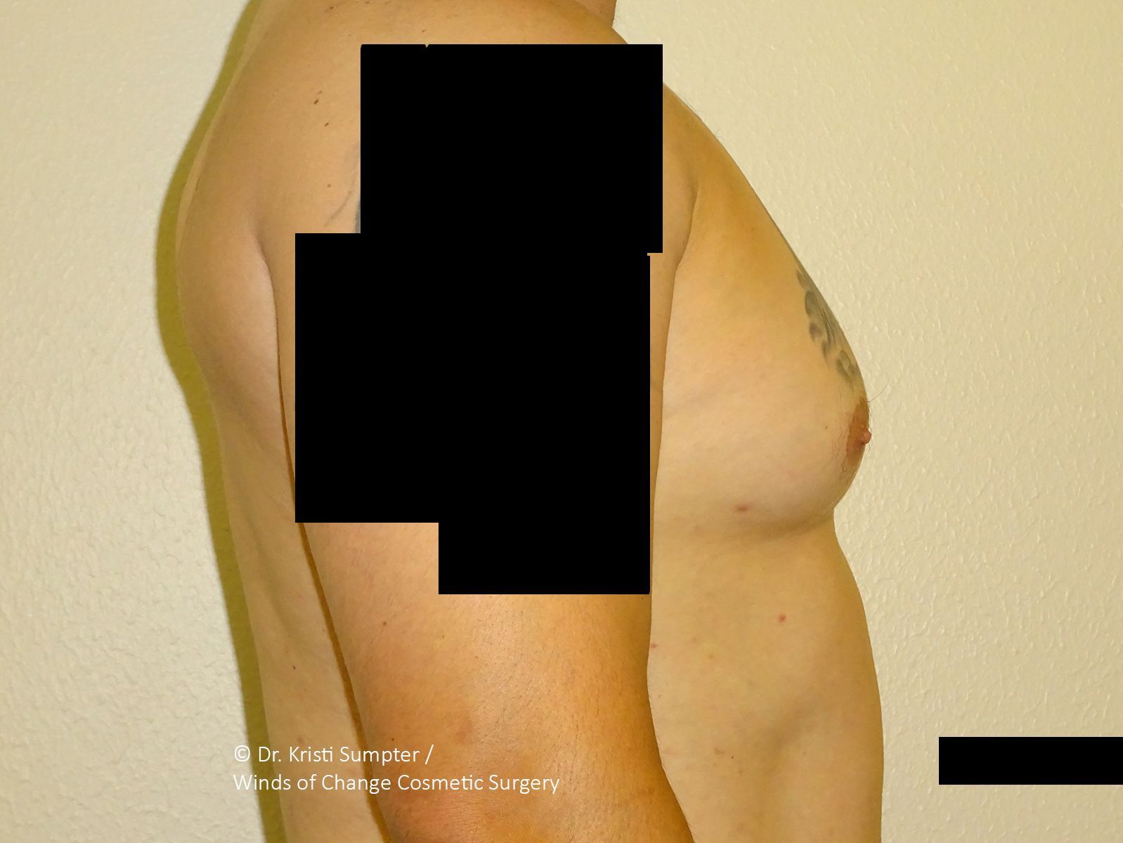 Side profile of a bare chest and upper arm, showing a surgical result or cosmetic appearance of the pectoral area.