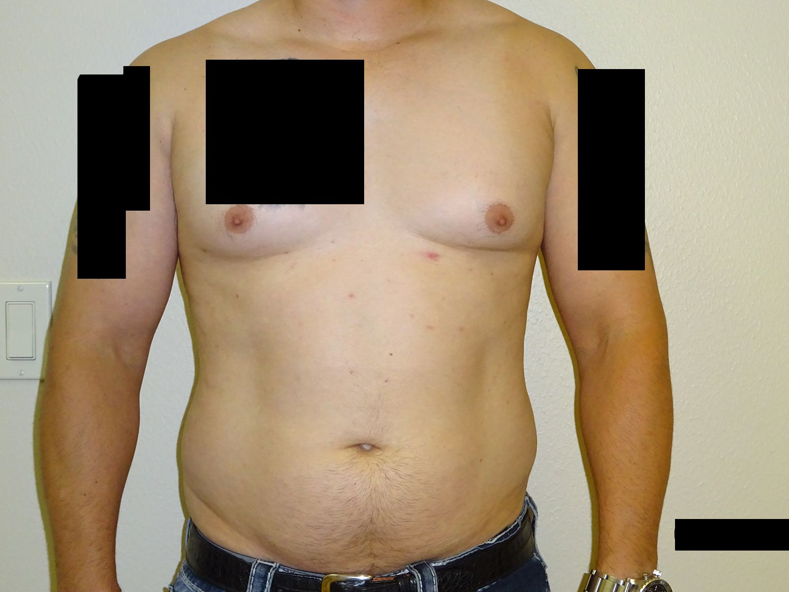 A front-facing view of a person’s torso and arms against a plain background, with black boxes obscuring parts of the chest.