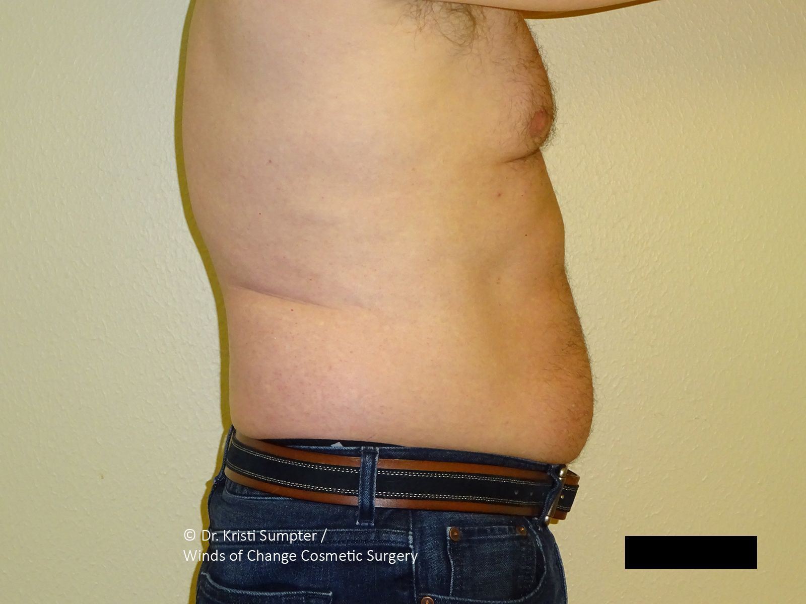 Side view of a person's midsection and torso, showing abdominal skin and soft tissue.