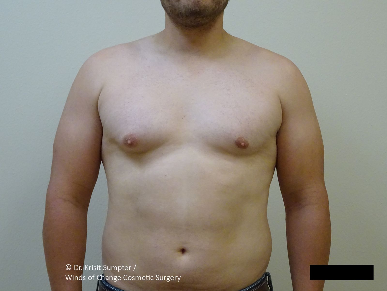 A front-facing view of a torso showing excess skin and fatty tissue in the chest and abdominal area.