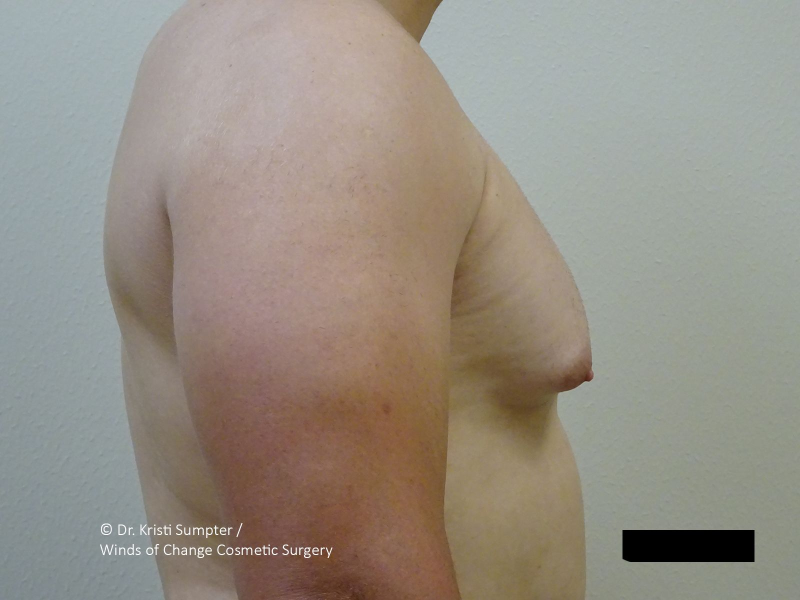 Side profile view of a torso showing chest tissue enlargement.