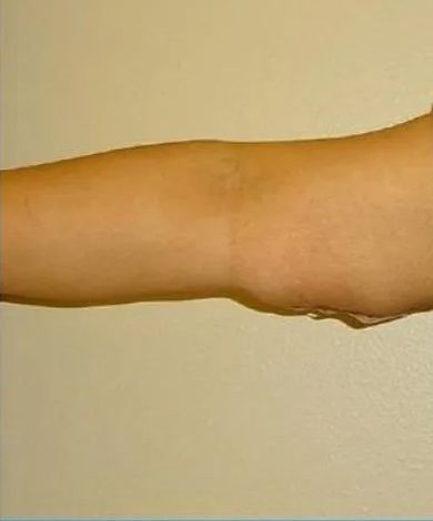 Tan human arm against a light background. Arm is slightly bent at the elbow.