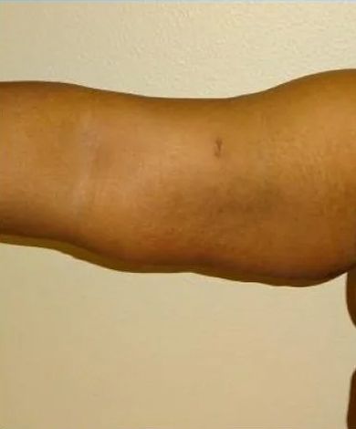 Close-up of human arm, with slightly discolored skin and a small scar.