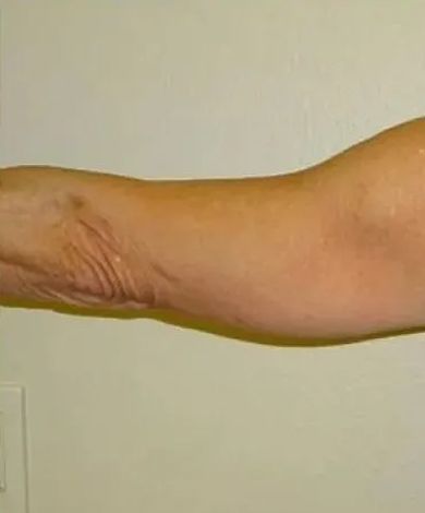 An arm, with wrinkles, is extended horizontally. The skin is light brown with some darker discoloration.