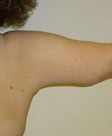 A person's upper arm, extended horizontally, displaying skin. Arm appears pale with some freckles.
