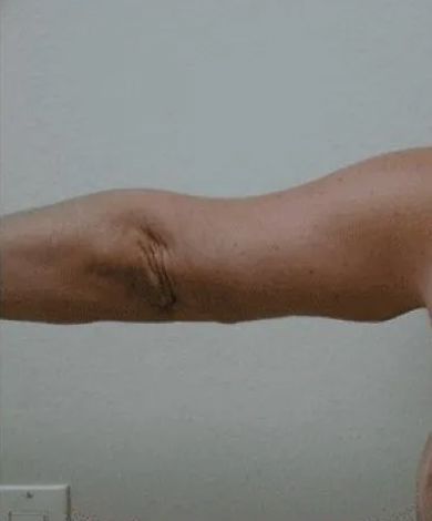 Bent human arm with loose skin and visible veins against a plain white wall.