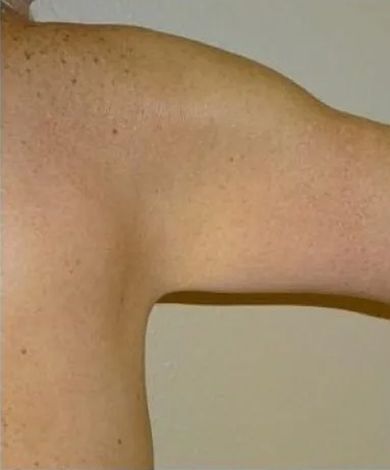 Shoulder and upper arm with many small, brown spots on light skin.