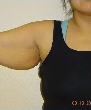 Arm with excess skin, wearing black tank top.