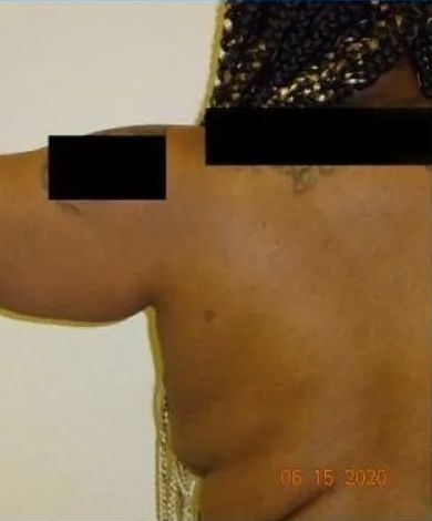 Torso and arm with black censor bars, likely pre-surgical. Light skin, indoors.