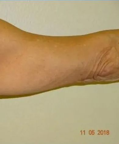Close-up of a pale arm with visible wrinkles, slight discoloration