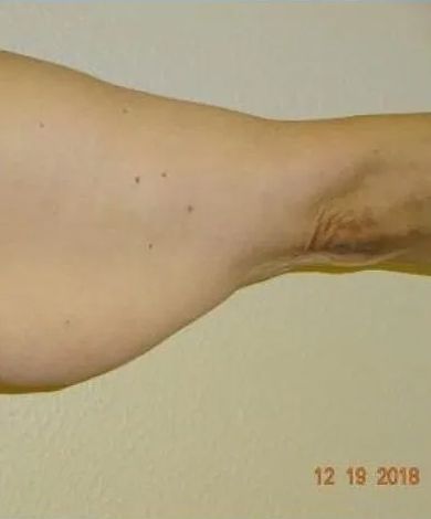 Arm with some moles and a dark bruise.