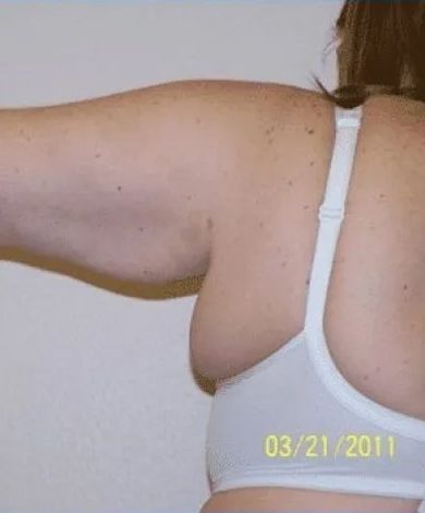 Person's upper body with arm extended. Wearing a white bra, shows the back and arm with freckles