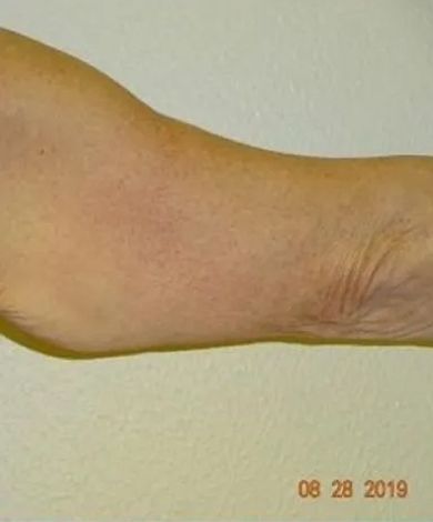 Arm, bent at the elbow, showing skin with slight discoloration, against a white background.