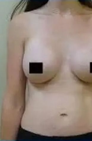 Torso of a person with breasts, nipples obscured by black squares, against a plain background.