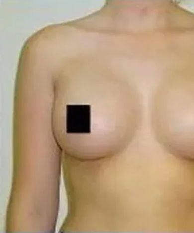 Woman's bare torso with a black square covering one nipple.