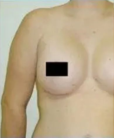 Chest and arm of a person with a blacked-out area covering the nipple, fair skin.