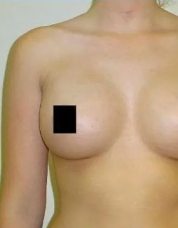 Upper torso of a person; one nipple obscured by a black square. Beige skin.