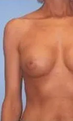 Nude torso of a person with one visible breast and arm on a blue background.