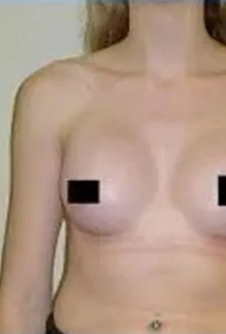 Torso with two breasts, nipples covered with black squares, pale skin.