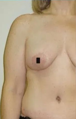 Naked torso; right breast with a dark square obscuring nipple. Arm is visible. Light background.