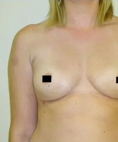 Woman with bare chest, torso visible. Chest area obscured with black squares.