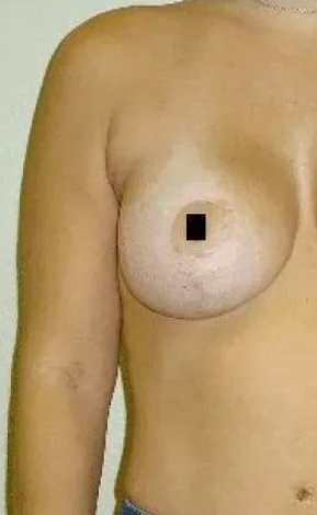 A person's torso with a breast, nipple area obscured by a black square.