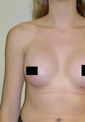 Woman's torso with breast implants, covered nipples, and a navel piercing.