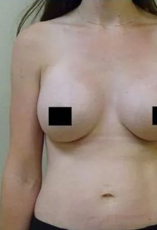 Woman with bare chest, black bars cover nipples. Plain wall in background.