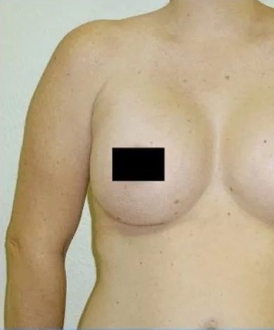 Upper torso of a person with a black box covering a nipple. Skin is light with freckles.