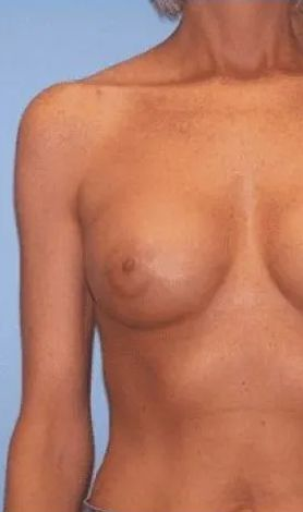 Torso, breasts of a person against a blue background, showing skin texture and slight asymmetry.