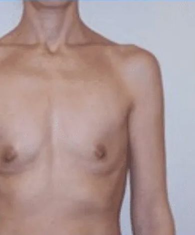 Torso of a person with visible tan lines on their chest and shoulders, with a neutral expression.