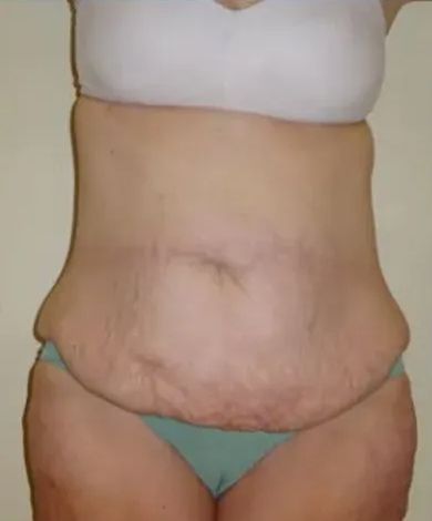 Torso of a person with loose skin and stretch marks, wearing a white bra and teal underwear.